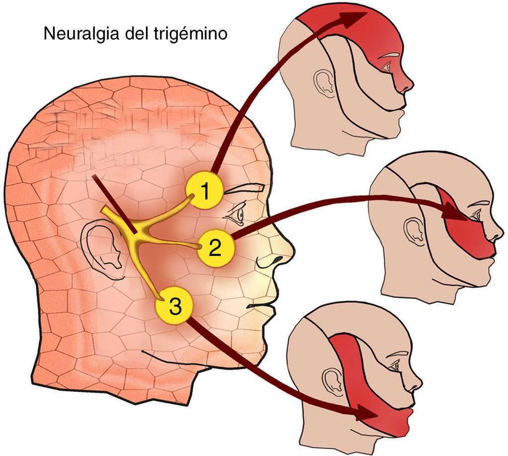 Воспаление нерва можно ли греть. Тройничный нерв. Тройничный нерв нерв. Лицевой троичный тройничный нерв. Тройничный нерввлсполение.