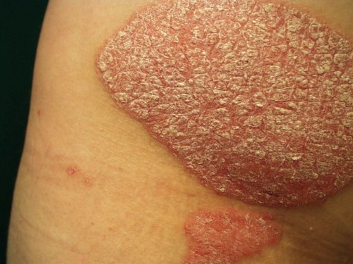 hagyományos orvoslás pikkelysömör kezelése vörös foltok piros pont a lábakon
